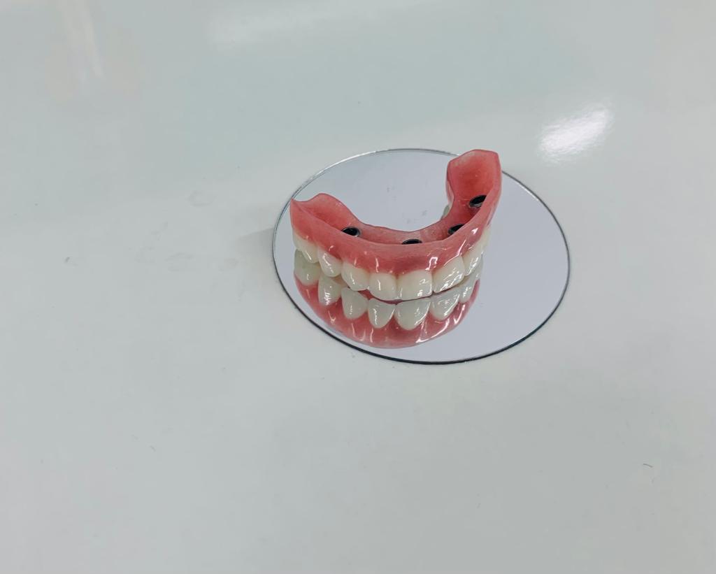 Proteză fixă pe mini implanturi dentare, Imperial Dent Timișoara