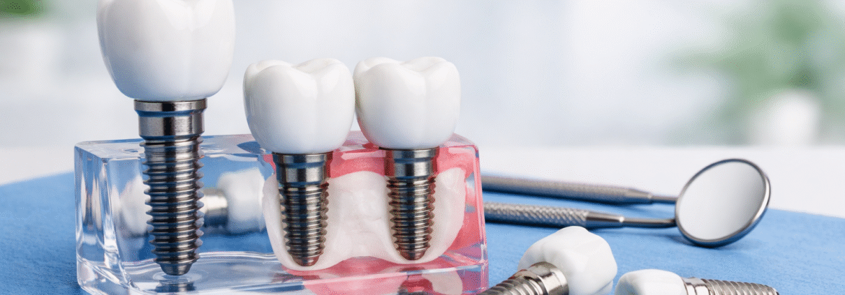 implant dentar timisoara model demonstrativ implanturi dentare