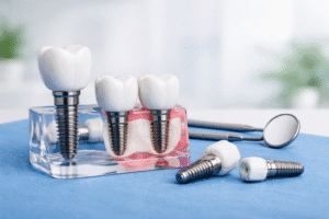 implant dentar timisoara model demonstrativ implanturi dentare