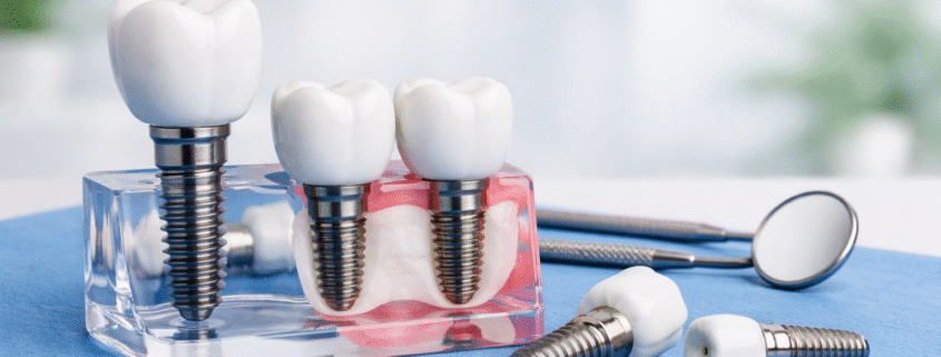 implant dentar timisoara model demonstrativ implanturi dentare