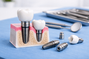 implant dentar timisoara structura implant dentar sectiune os si coroana