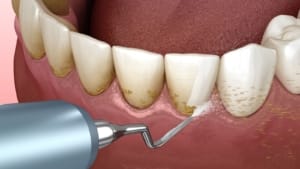 Detartraj dentar profesional în Timișoara – igienizare realizată la Imperial Dent