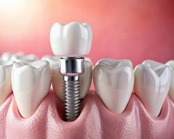 Preț implant Dentar Timișoara