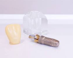 Implant Dentar Timișoara