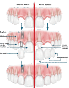 implant dentar Timișoara – soluție sigură și naturală la Imperial Dent