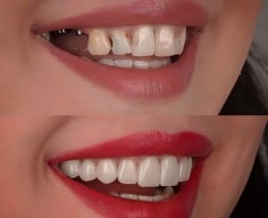 Zâmbet natural obținut după implant dentar, rezultat final pentru pacient la Imperial Dent