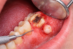 Infecție dentară avansată care necesită tratament stomatologic de urgență