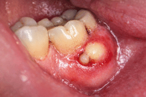 abces dentar – infecție gingivală cu puroi și inflamație