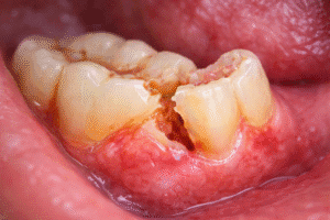 dinte spart durere dentară Timișoara – problemă stomatologică frecventă