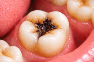 pacient cu durere dentară cauzată de carie avansată