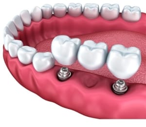 Soluție modernă de înlocuire a dinților lipsă prin implant dentar, parte din serviciile stomatologice complete Imperial Dent.