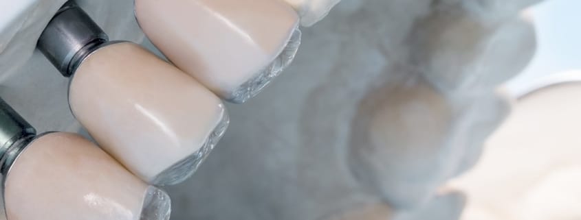 Implant dentar în Timișoara – coroane dentare fixate pe implant