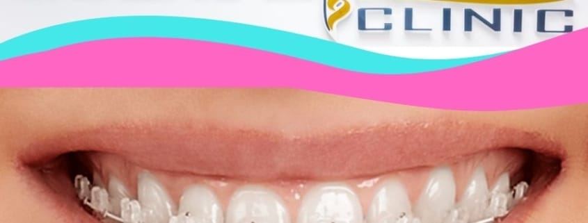 Aparat dentar ceramic aplicat la pacient în Timișoara