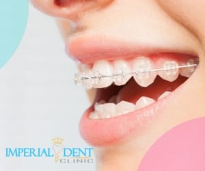 Aparat dentar ceramic discret aplicat la pacient în Timișoara