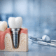 cât rezistă un implant dentar – implant dentar modern utilizat în implantologie