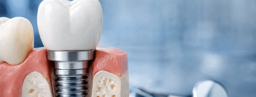 cât rezistă un implant dentar – implant dentar modern utilizat în implantologie