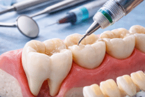 tratament plombă dentară pentru carii în Timișoara