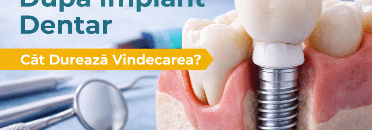 vindecarea dupa implant dentar si procesul de osteointegrare