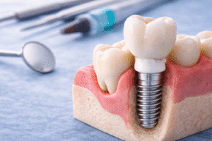 procesul de osteointegrare și vindecarea dupa implant dentar