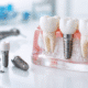 cel mai bun implant dentar Timisoara rezultat natural implant