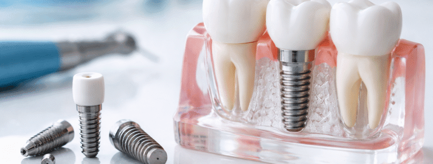 cel mai bun implant dentar Timisoara rezultat natural implant