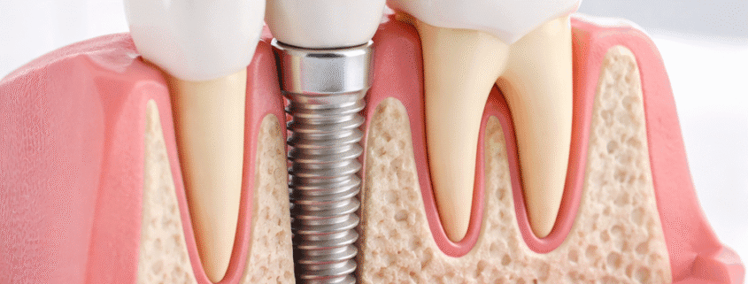 implant dentar cu coroană ceramică demonstrat pe model dentar