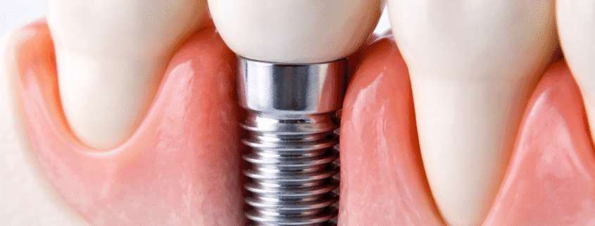 tratament implant dentar Timișoara demonstrat pe model dentar cu implant și coroană ceramică