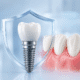 implant dentar Timișoara sigur protecție și stabilitate implant