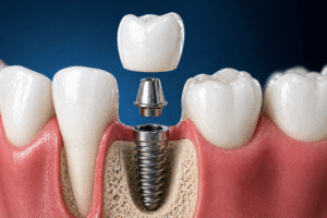 cât timp poți sta fără dinte soluție implant dentar structură completă