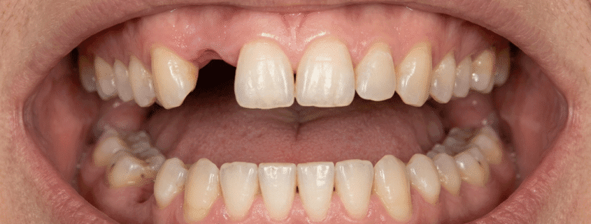 Greseli dupa pierderea unui dinte