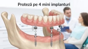 proteza pe 4 mini implanturi Timisoara schema fixare lucrare dentara pe implanturi