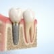 structura implant dentar și coroana pe implant