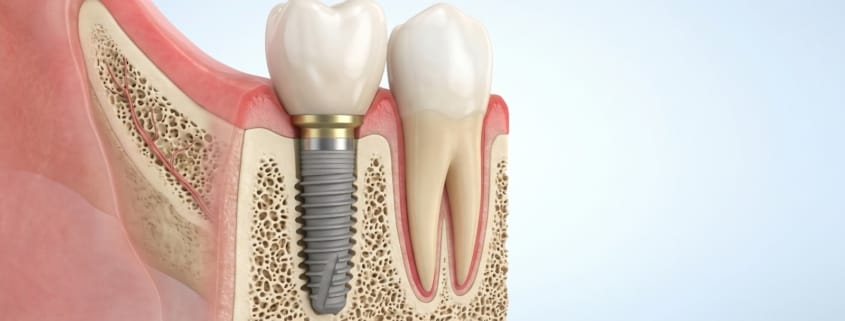 structura implant dentar și coroana pe implant