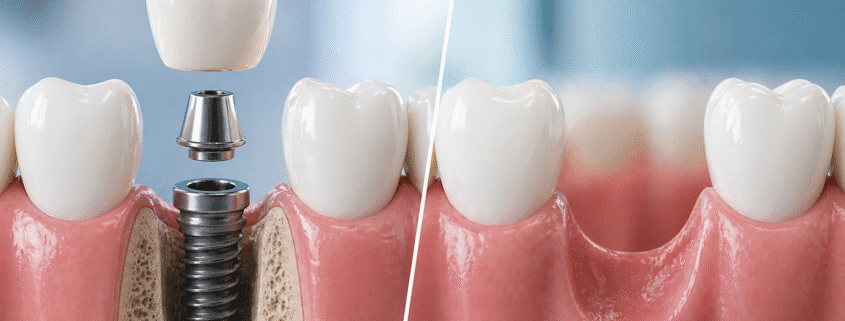 cât timp poți sta fără dinte și soluția implant dentar Timișoara