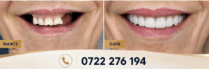rezultat implant dentar înainte și după Imperial Dent Clinic Timișoara