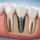 implant dentar modern integrat în os ilustrație 3D