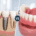 implant dentar sau proteză mobilă comparație tratamente dentare Timișoara