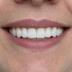 implant dentar Timișoara rezultat natural caz real pacient