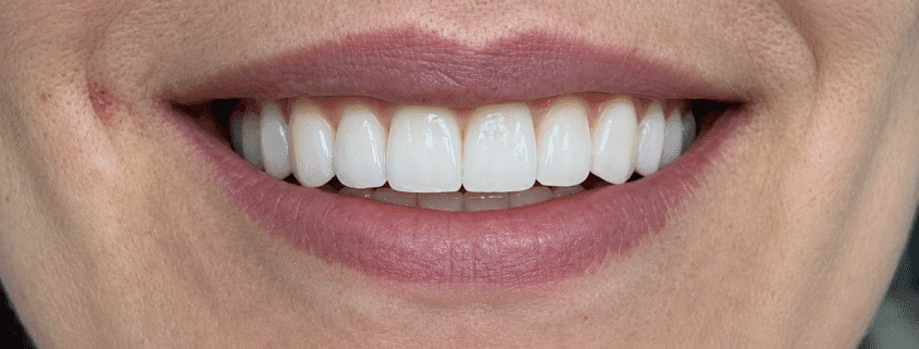 implant dentar Timișoara rezultat natural caz real pacient