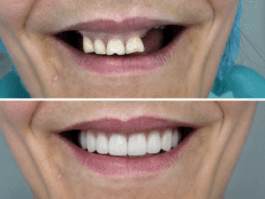 implant dentar Timișoara înainte și după rezultat real pacient