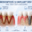 parodontoză și implant dentar comparație între pierdere osoasă și tratament implantar