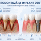 parodontoză și implant dentar comparație între pierdere osoasă și tratament implantar