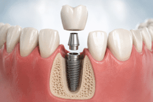 implant dentar modern structură completă coroană și implant Timișoara
