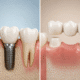 implant dentar sau punte dentară comparație tratamente stomatologice Timișoara