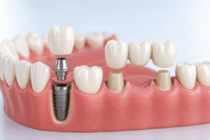 implant dentar sau punte dentară comparație soluții pentru dinte lipsă