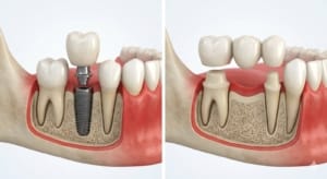 implant dentar sau punte dentară diferențe între tratamente și structură
