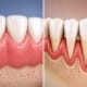 retracții gingivale comparație între gingie sănătoasă și gingie retrasă
