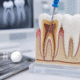 tratament de canal Timișoara ilustrație endodonție și rădăcina dintelui