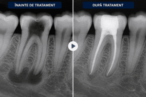 radiografie înainte și după tratament de canal Timișoara