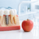 Ce mănânci după implant dentar – ilustrație cu implant dentar, măr și apă